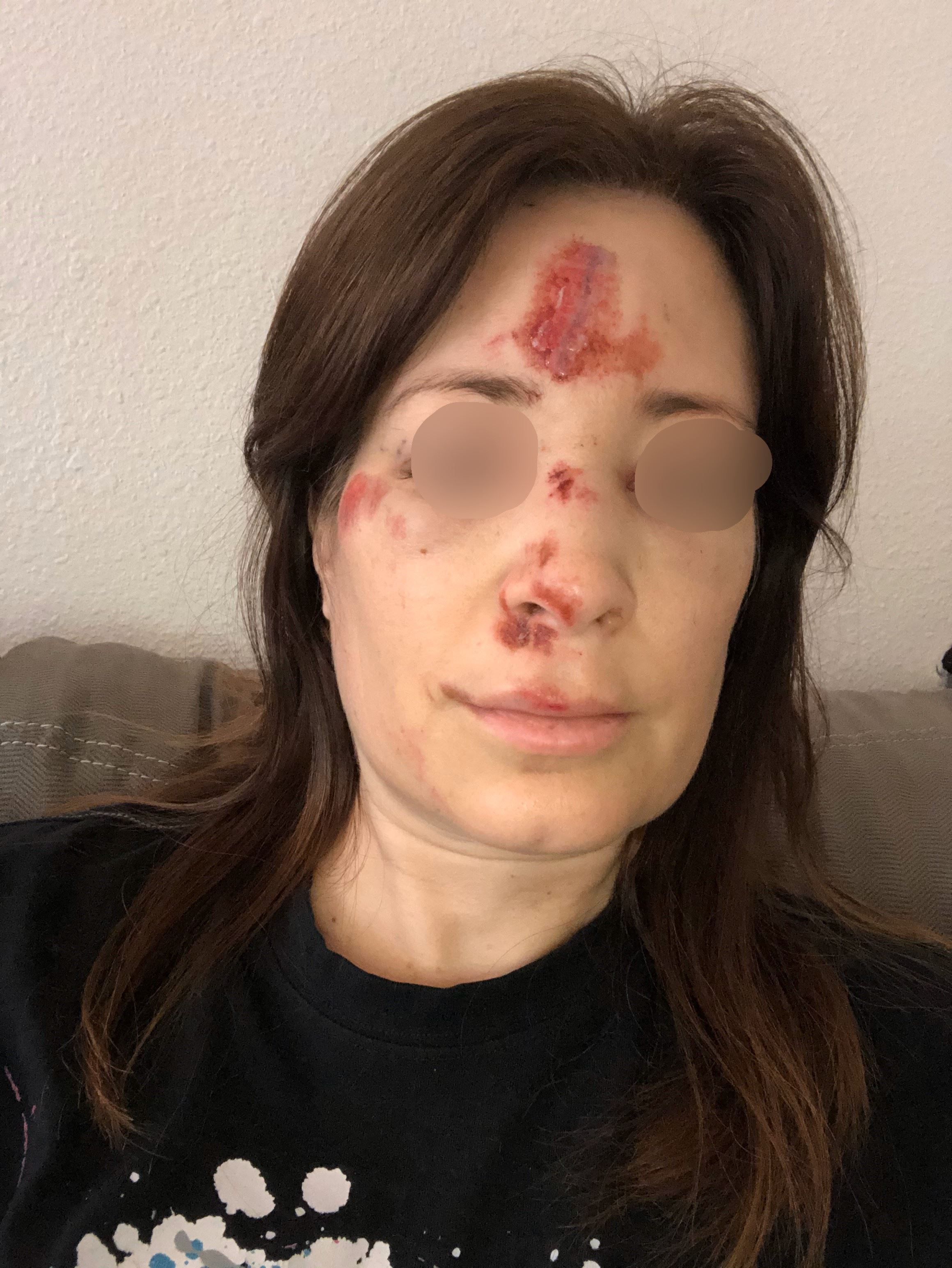 Woman with road rash on her face from e-scooter accident