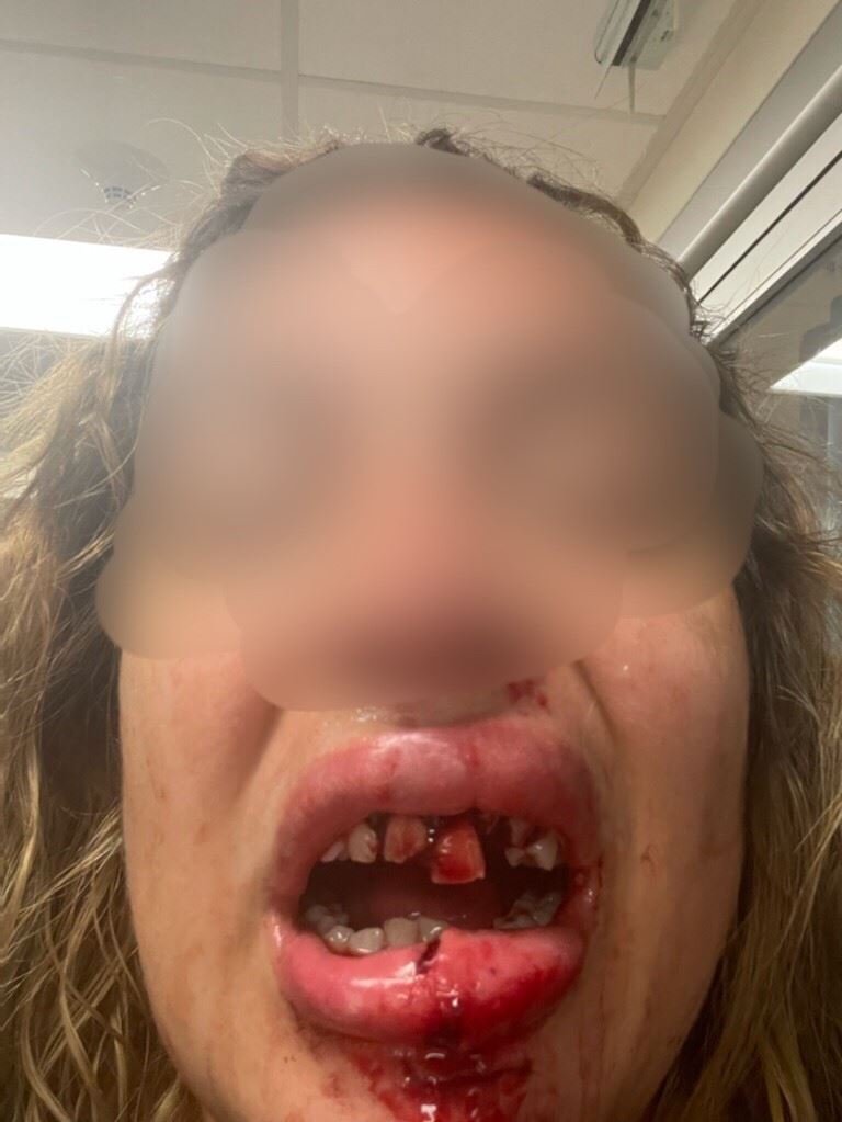victim with severe mouth and tooth injuries
