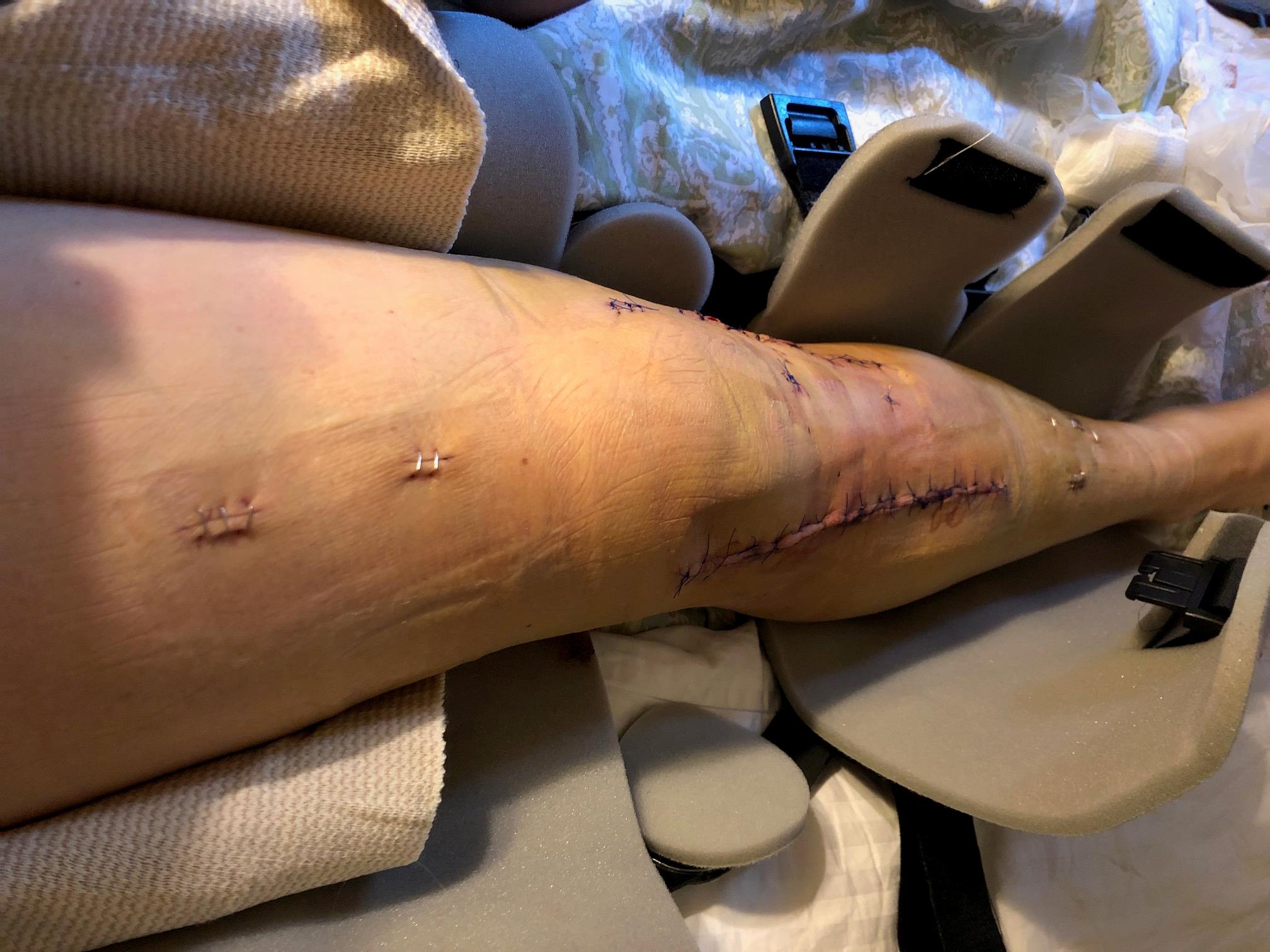 Stitched up shin after a scooter accident