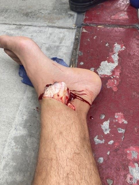 severe ankle injury with exposed bone