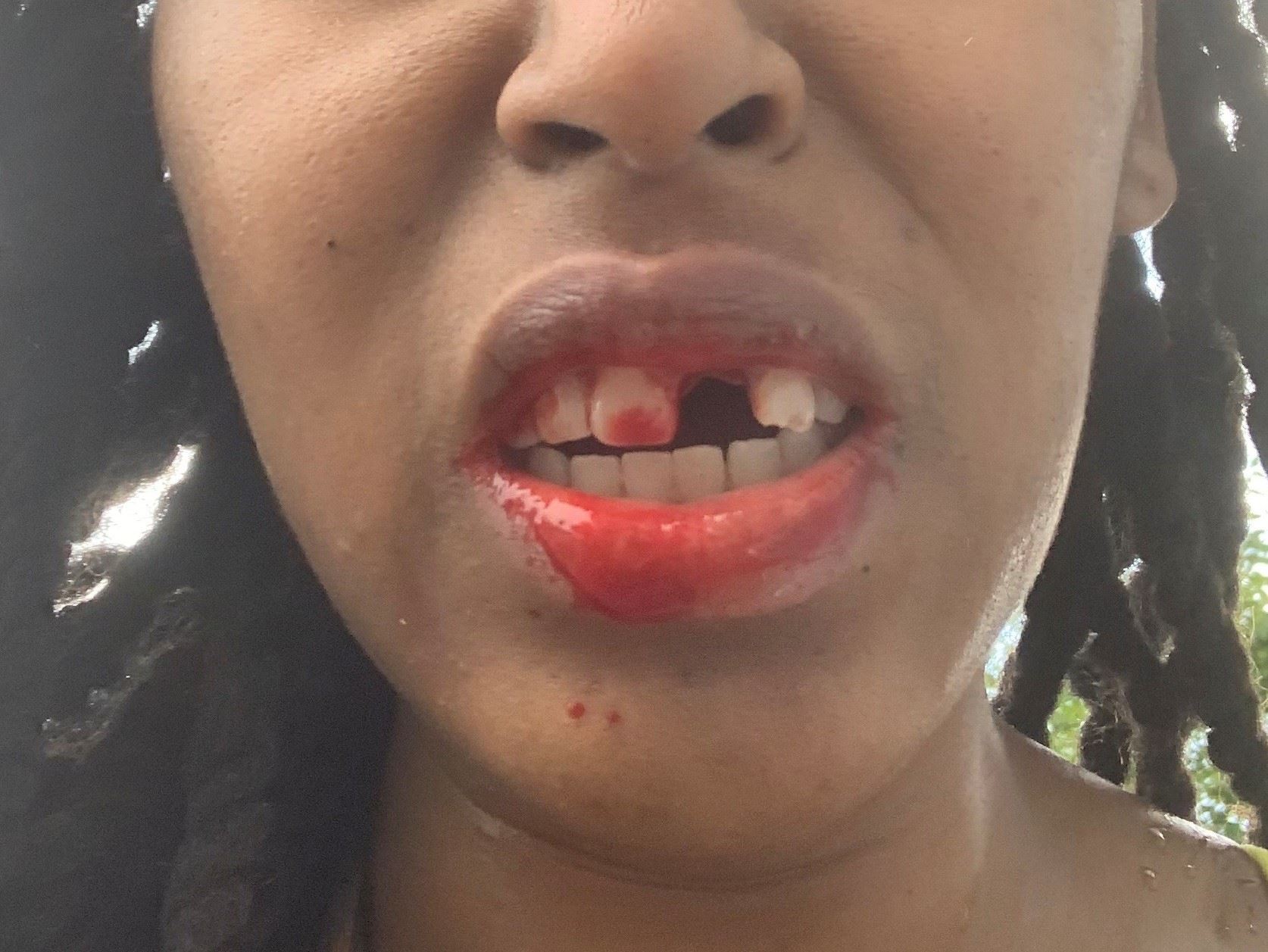 Close up image of a woman's mouth; tooth knocked out and blood on teeth and lips